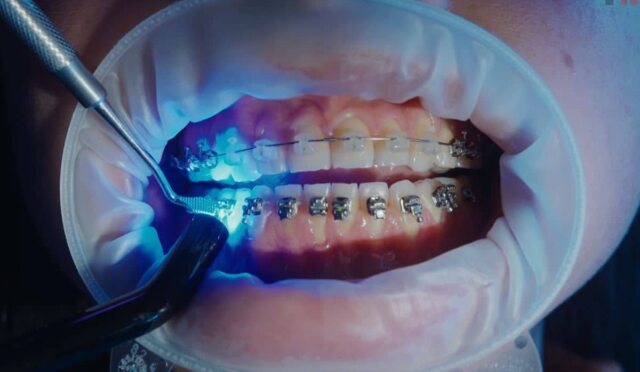 2023 Diş Teli Fiyatları: İzmir, Alsancak – Pro Estetik Diş Kliniği