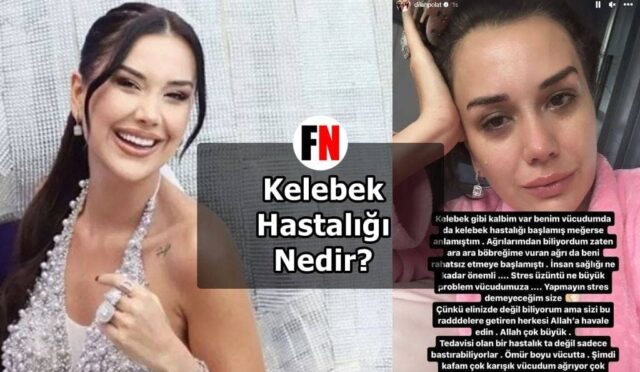 Kelebek Hastalığı Nedir?