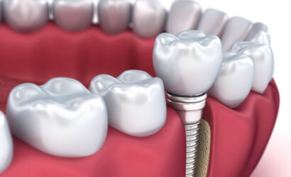 İmplant Tedavisi İçin En Uygun Zaman Ne Zaman