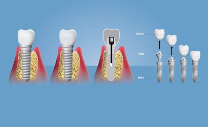 Diş İmplantlarının Avantajları ve Dezavantajları