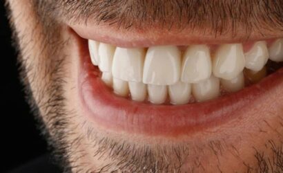 Diş Kaplamaları Kalıcı mı?