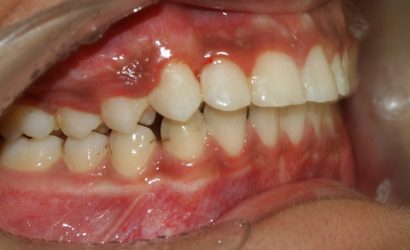 Diş Etlerinde Renk Değişikliği Neden Olur?