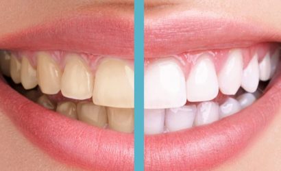 Diş Sararmasının Nedenleri Nelerdir?