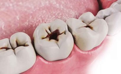 Kanal Tedavili Diş Çürür mü?