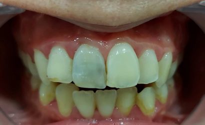 Kanal Tedavili Dişler Kararır mı