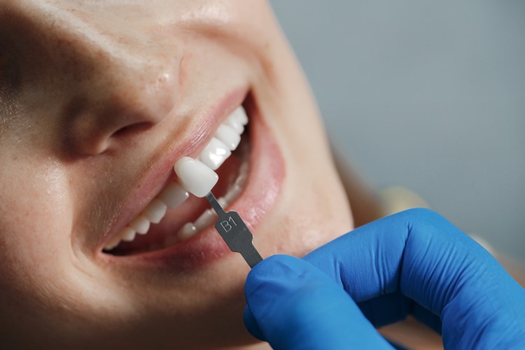 Zirkonyum Diş Kaplamada Dentvital’i Tercih Etmeniz İçin 10 Neden