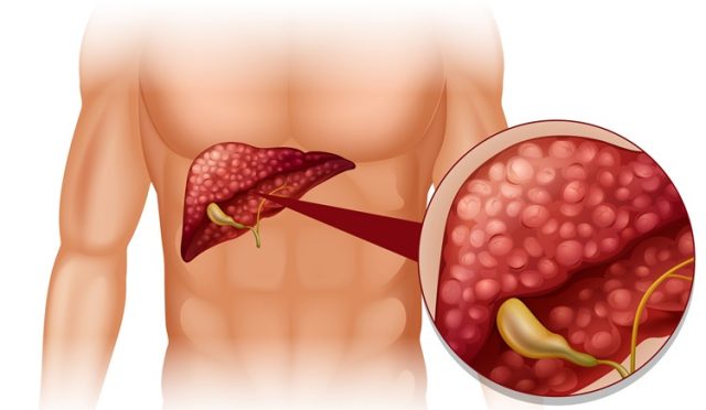 Karaciğer Yağlanmasıyla Vedalaşın: Dr. Seren'den Sağlıklı Beslenme Rehberi