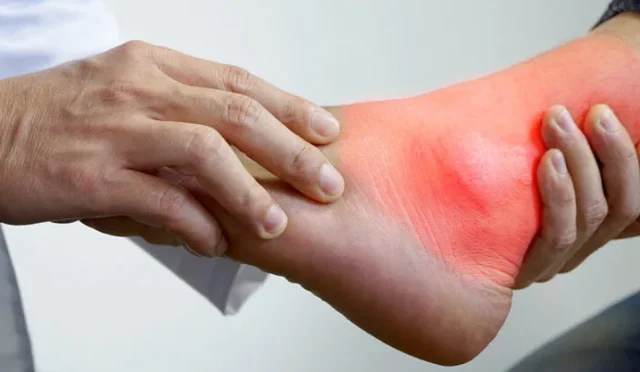 Gut Hastalığında Doğru Beslenme: Ürik Asit Kontrolü ve Sağlıklı Bir Yaşam