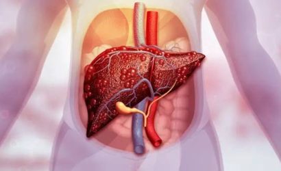 Karaciğer Yağlanmasıyla Savaşın: Beslenmeyle Sağlıklı Bir Karaciğere Merhaba Deyin!