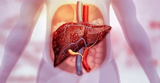 Karaciğer Yağlanmasıyla Savaşın: Beslenmeyle Sağlıklı Bir Karaciğere Merhaba Deyin!