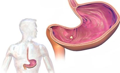 Ülser Hastalığında Doğru Beslenme: Midenizi Sakinleştirmenin ve İyileşmenin Anahtarı
