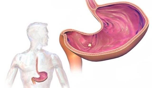 Ülser Hastalığında Doğru Beslenme: Midenizi Sakinleştirmenin ve İyileşmenin Anahtarı
