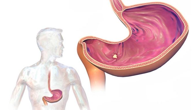 Ülser Hastalığında Doğru Beslenme: Midenizi Sakinleştirmenin ve İyileşmenin Anahtarı