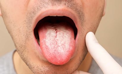 Candida Hastalığı ve Beslenme Tedavisi: Dr. Seren'den Kapsamlı Rehber