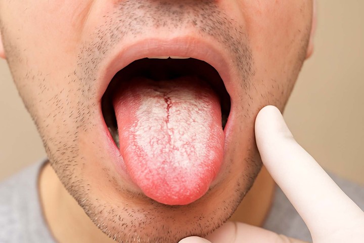 Candida Hastalığı ve Beslenme Tedavisi: Dr. Seren’den Kapsamlı Rehber