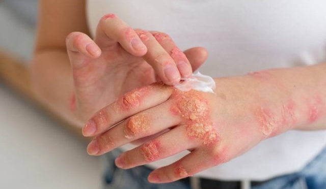 Egzamanın Gizli Kahramanı: Bağırsak Floranızla Cilt Sağlığınıza Yeniden Merhaba Deyin!